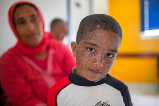 When Light Is Lethal: Moroccans Struggle with Skin Disorder