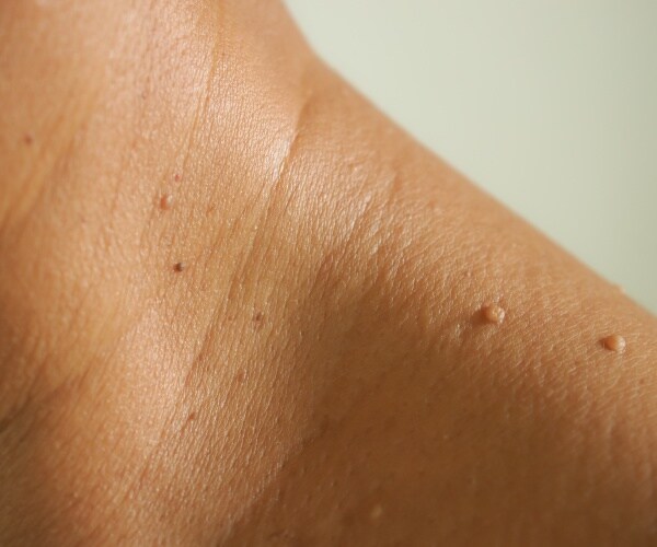 skin tags on shoulder