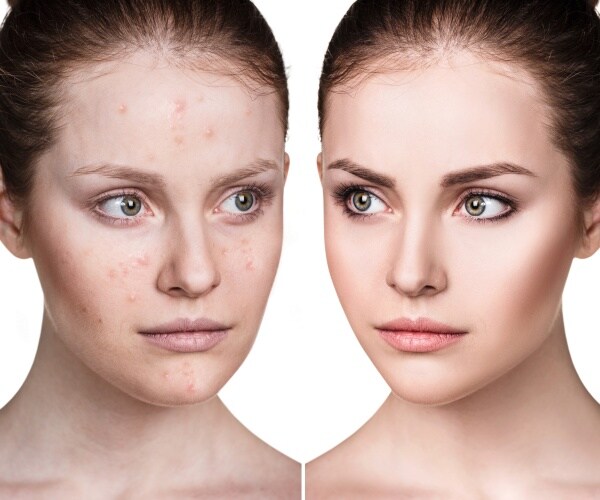 two pictures of a woman -- first with acne, second clear of acne