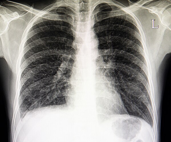 a chest x-ray