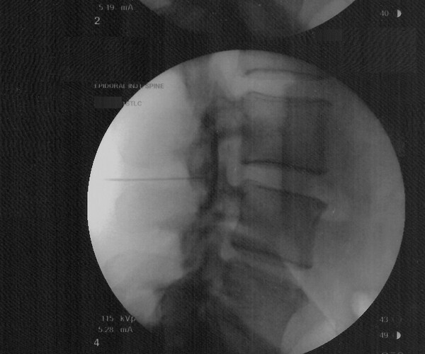 Epidural Needle Tip Found in Woman's Spine After 14 Years of Pain