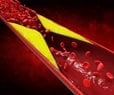 Lower Cholesterol Cuts Risks From Clogged Arteries