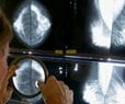 Pandemic Disruptions to Health Care Worsened Cancer Survival, Study Suggests