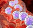 Genetic Test May Predict Leukemia Relapse Risk