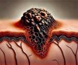 Approved Immunotherapy Shrinks Aggressive Melanoma