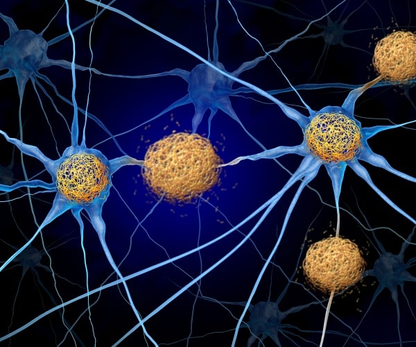 Why Cancer Might Protect Against Alzheimer's